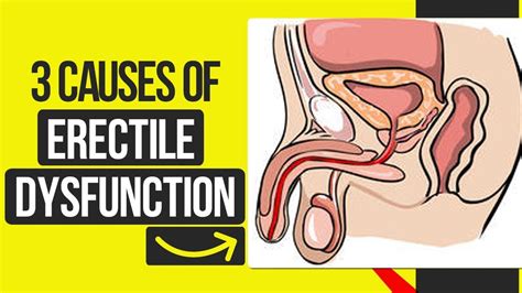 3 Causes Of Erection Problems That You Can Fix Today And Revive Your