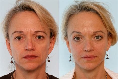 Botox Cosmetic Photos Houston Tx Patient