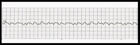 Practice EKG Strips 380