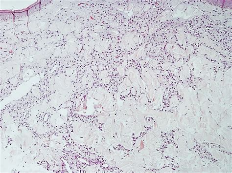 Case for diagnosis. Erythematous-violaceous reticulated plaques on the