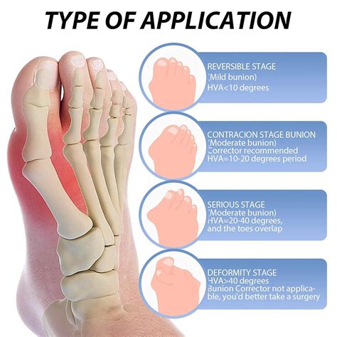 XerTeam Women's Ball Toe Set | 6-Piece Orthopedic Hallux Valgus Bandage