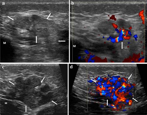 Purely Subcutaneous Infantile Hemangioma And Precursor Lesion In A