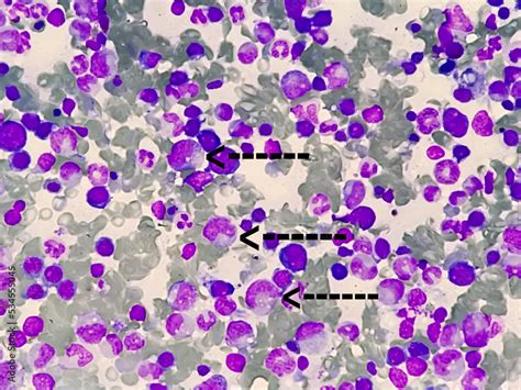 Microscopic Image Of Bone Marrow Plasma Cell Dyscrasia Or Multiple