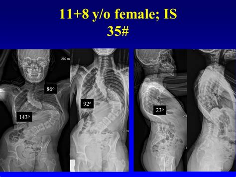 Blog Post Severe Scoliosis Treated With Preoperative Halo Gravity