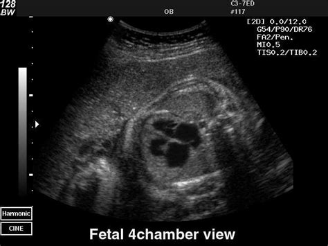 Obstetrics Fetal 4 Chamber View Echogramm №38 Was Received By The