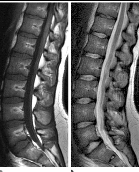 Sagittal A T1 And B T2 Weighted MR Images Of The Lumbar Spine