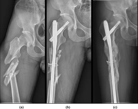minimally invasive cerclage wiring  displaced major fragments