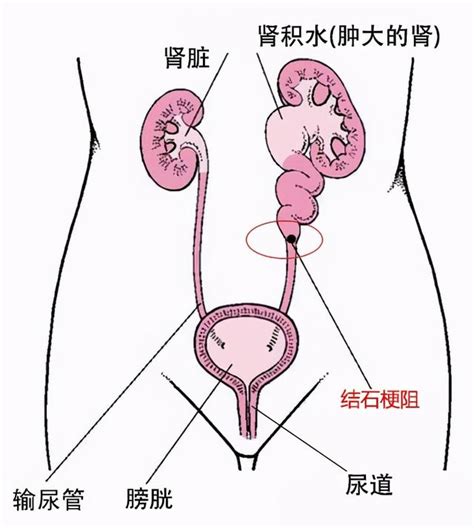 從結石引發泌尿道梗阻，到腎功能重度受損，僅僅用了三個月 每日頭條