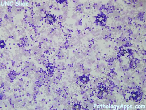 Viral Encephalitis Csf Cytology