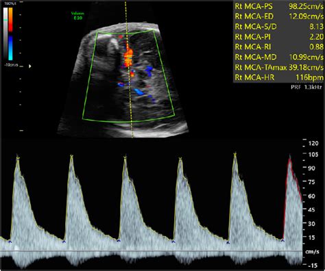 Fetal Hypertrophic Cardiomyopathy With Elevated Middle Cerebral Artery Peak Systolic Velocity