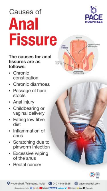 Anal Fissure Symptoms Causes Types Complications Prevention Artofit