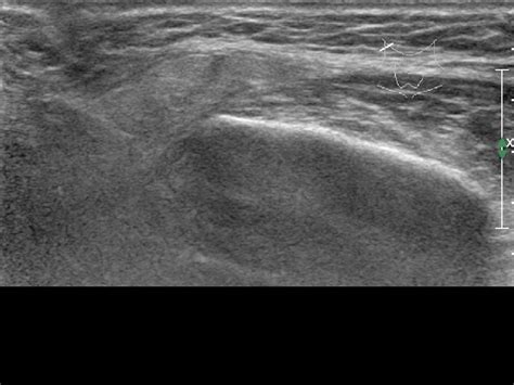 Botoxxeominbotulinum Toxin Injection To Salivary Glands For Drooling