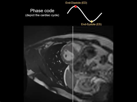 efficient  phase aware video super resolution  cardiac mri