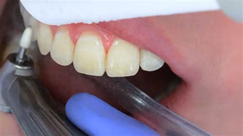 Fluorosis: Causes, Diagnosis, Management, and Prevention