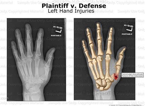 Left Thumb Fracture - MotionLit