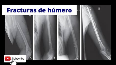 Fracturas Diafisiarias De H Mero Youtube