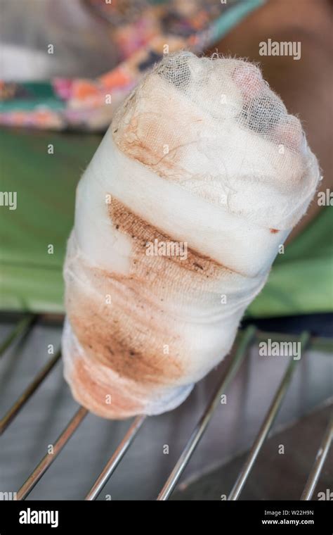 Infected wound of diabetes foot Stock Photo - Alamy