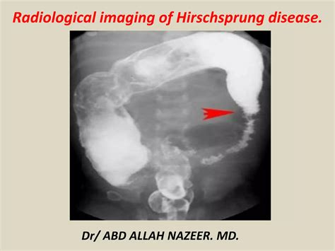 Presentation1, radiological imaging of hirshsprung disease. | PPTX