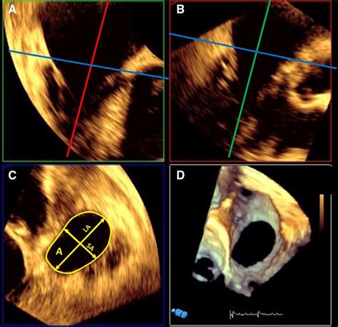 Measurements Of The Tricuspid Annulus Using 3 Dimensional Download