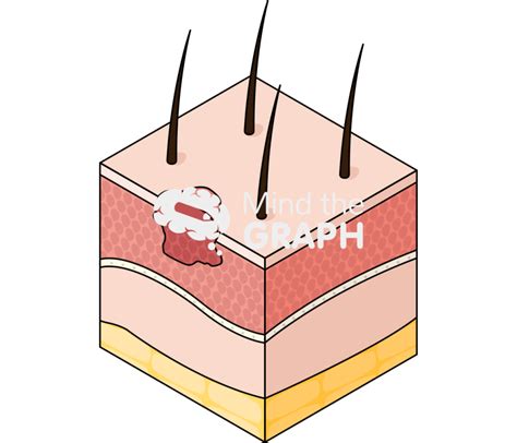 Squamous Cell Carcinoma Skin Perspective