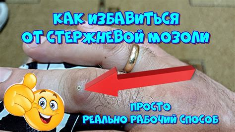 Как избавиться от стержневой мозоли. Простой и реально рабочий способ 👍 ...