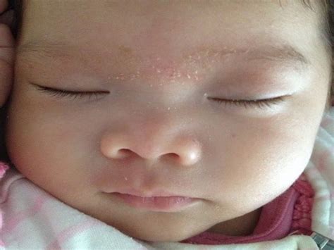 Neonatal Group B Strep Rash