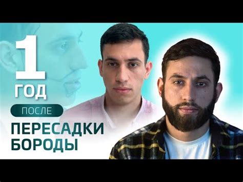 Пересадка бороды в Турции, борода выросла - YouTube