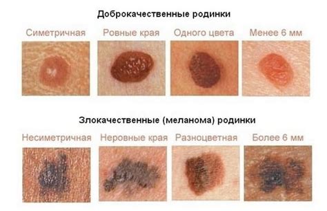 Удаление кератом: показания, методы лечения | Food and Health
