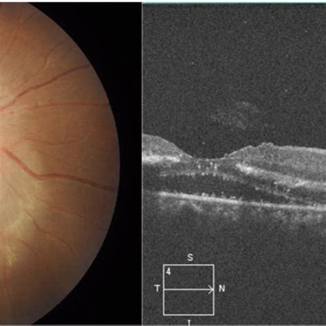 Patient no. 12. SD-OCT of the left eye: swollen ONH with overlying ...