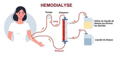 Dialyse Indications D Roul Esp Rance De Vie