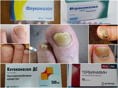 Народное средство от грибка на ногах - методы быстрого лечения ...