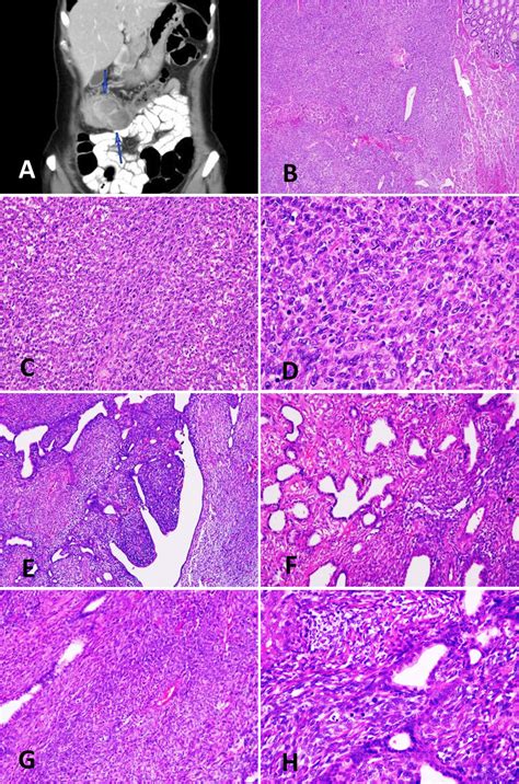 Adult Ntrk Rearranged Spindle Cell Neoplasms Of The Viscera With An