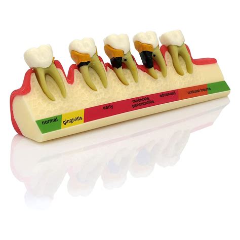 Buy Teeth Periodontal Disease Model Dental Caries Breakdown Display