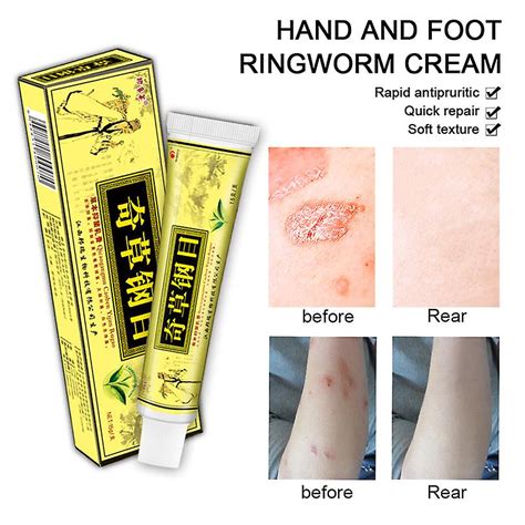 1pc Skin Psoriasis Cream Dermatitis Eczematoid Eczema Ointment Scalp Treatment Fruugo Se