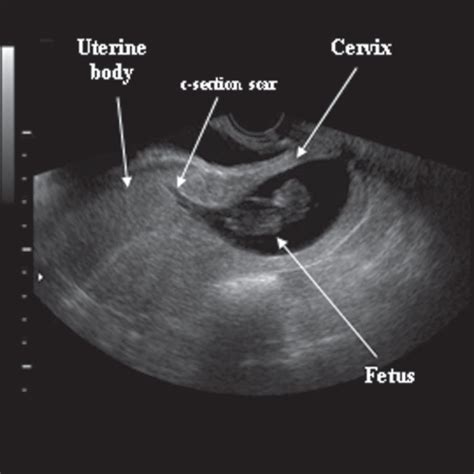 Three Dimensional Ultrasonographic Diagnosis Of A Cervical Pregnancy