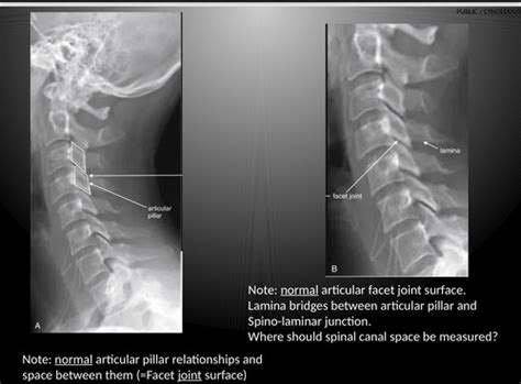 part  articular pillar fracture  avulsion fracture  spinous