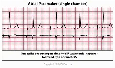 Ekg Ecg Interpretation Course Ceufast Nursing Continuing Education