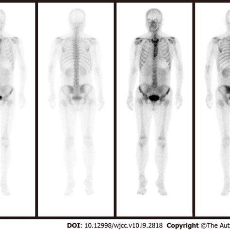 Single Photon Emission Tomography Combined With Computed Tomography