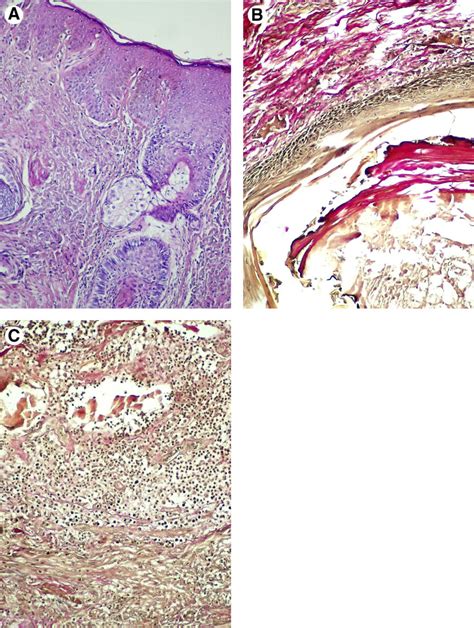 Microphotograph Of Histologic Specimen A Epidermis With Irregular