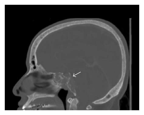 Computed tomography of skull that shows a heterogeneous, osteolytic... | Download Scientific Diagram