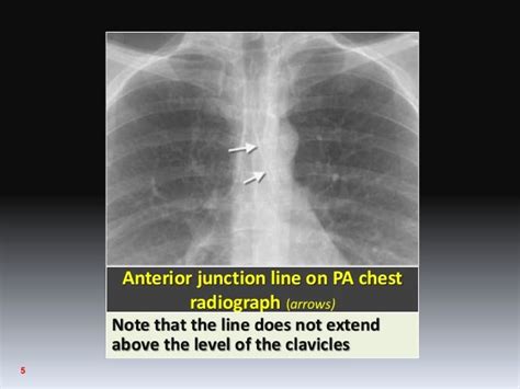 Lines & mediastinal stripes 02