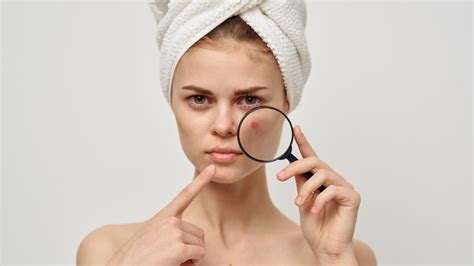 The Top Eight Acne Treatments Tamara Like Camera