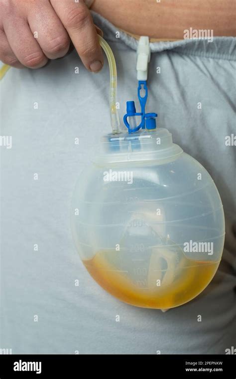 surgical drainage works  christopher lewis blog