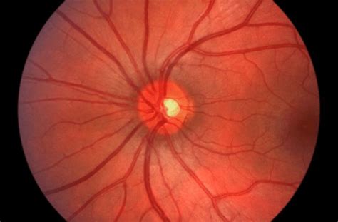 optic neuritis  neuropathy symptoms  treatments