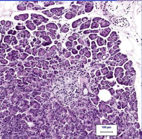 Lecture 18 Pancreatic Pathology And Diabetes Flashcards Quizlet