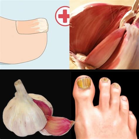Instantly Removes Nail Fungus Like an Eraser! ? Natural Remedy with