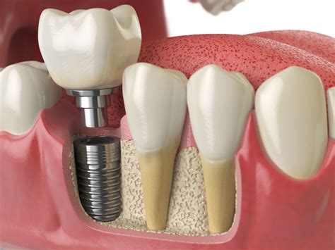 The 4 Main Benefits Of Dental Implants