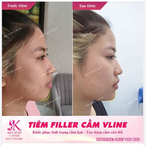 ThẨm MỸ NỘi Khoa LÀm ĐẸp KhÔng CẦn PhẪu ThuẬt TẠo HÌnh BẰng Filler