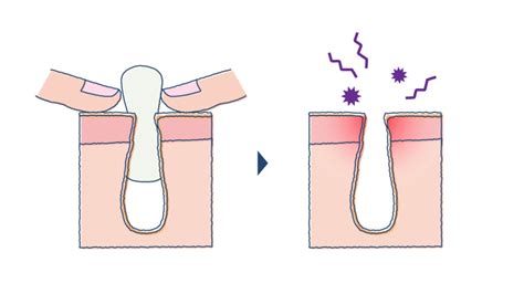 角栓の正しい取り方を徹底解説！ng行動やおすすめのクレンジング＆洗顔をチェック ハダメディア By Bihadadotokyo