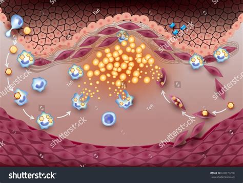 stable atherosclerotic plaque formation human artery stock vector